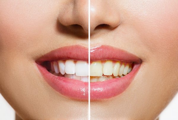 Răng bị ngả màu, nhiễm màu nặng không thể tẩy trắng thì có thể bọc răng sứ