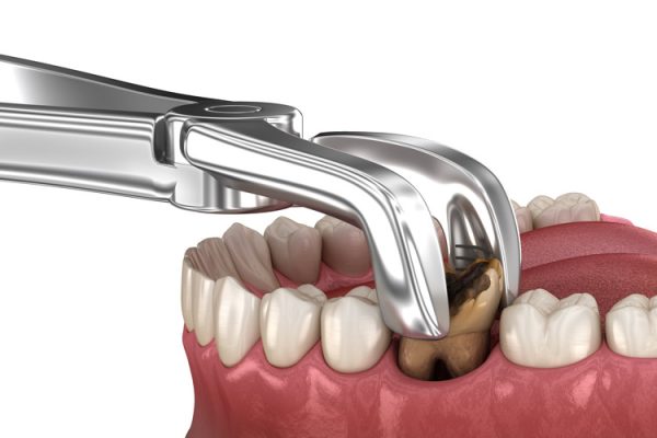 Thủ thuật nhổ răng thường được áp dụng trong việc loại bỏ răng mắc một số bệnh lý nghiêm trọng