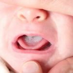 Cách chữa nấm miệng cho trẻ phòng ngừa tái phát