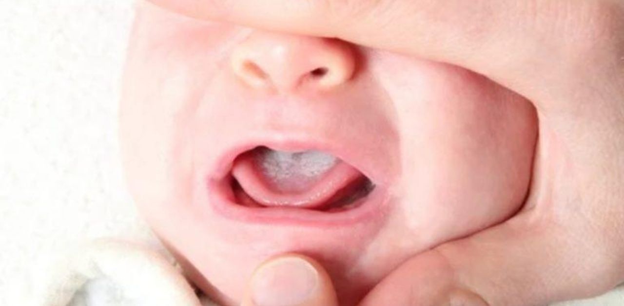 Nấm miệng ở trẻ dưới 1 tuổi có thể lây nhiễm cho người khác không?
