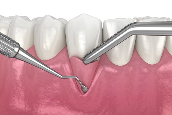 Phẫu thuật cắt viền nướu là phương pháp hiện đại giúp loại bỏ mô nướu thừa trên cung hàm, giúp kéo dài thân răng