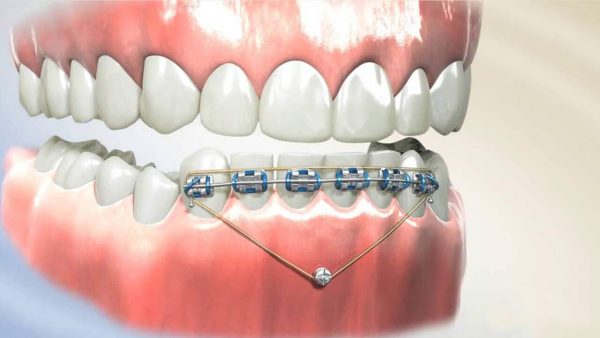 Niềng răng gắn minivis là cách điều trị cười hở lợi không thẫu thuật, áp dụng trong trường hợp mức độ hở lợi chỉ từ 1-2mm