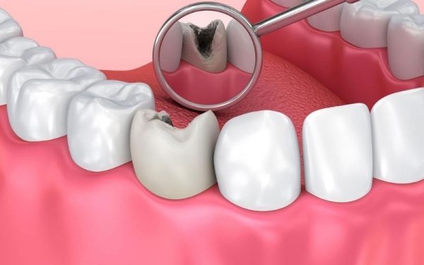 Bệnh sâu răng không thể tự khỏi và có xu hướng diễn tiến nặng, gây ra nhiều vấn đề nguy hiểm nếu không được điều trị tận gốc