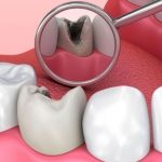Bỏ túi cách điều trị sâu răng tại nhà hiệu quả