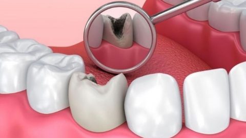 Bỏ túi cách điều trị sâu răng tại nhà hiệu quả