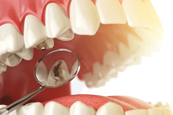 Sâu răng là một trong những nguyên nhân hàng đầu khiến mọi người bị hôi miệng, hơi thở có mùi
