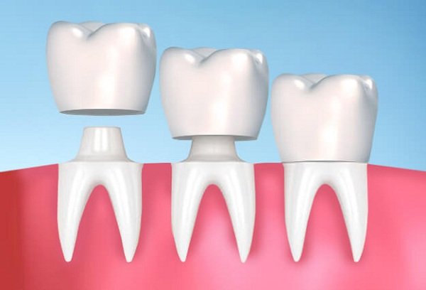 Chăm sóc răng sau khi làm răng sứ giúp tăng tuổi thọ của răng sứ và ngăn ngừa bệnh lý răng miệng