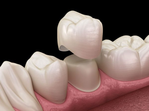 Bọc răng sứ là kỹ thuật nha khoa hiện đại giúp nâng cao tính thẩm mỹ cũng như cải thiện khiếm khuyết ở hàm răng
