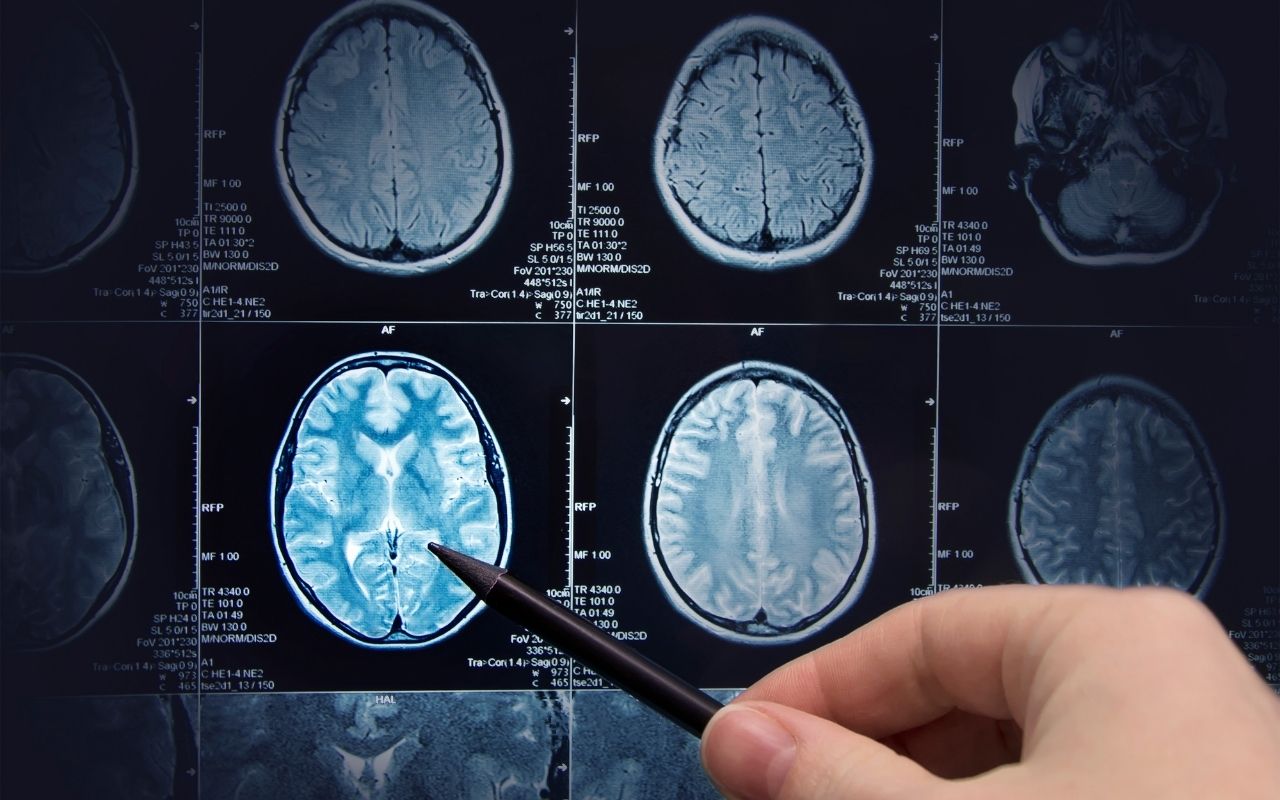 Chụp cắt lớp não có đem lại những thông tin gì quan trọng về tình trạng sức khỏe của não?
