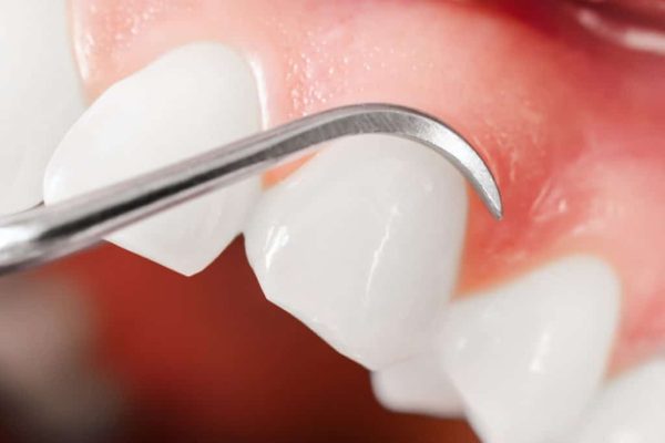 Điều trị viêm chân răng có mủ tại nha khoa bằng việc lấy cao răng, nạo sạch chất bám bẩn quanh lợi và tủy răng