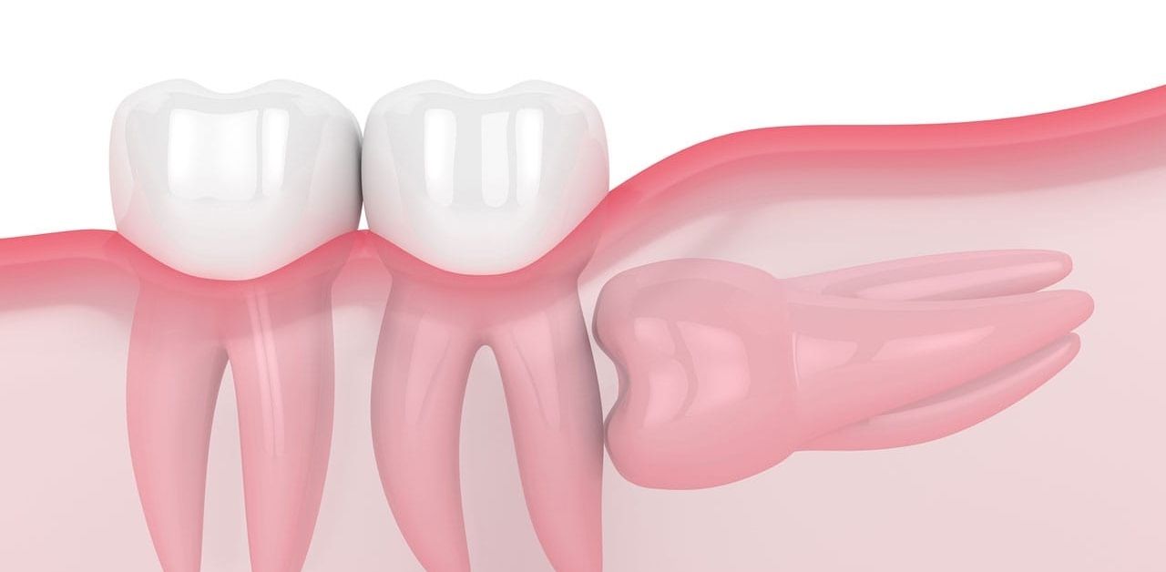 Có những triệu chứng nào cho thấy răng khôn đang mọc?
