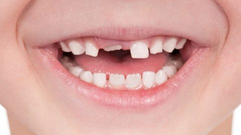 Có bao nhiêu răng sữa phải thay ở trẻ nhỏ?
