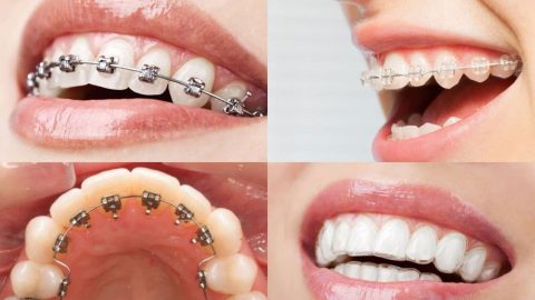 Có nên chọn nha khoa niềng răng giá rẻ?