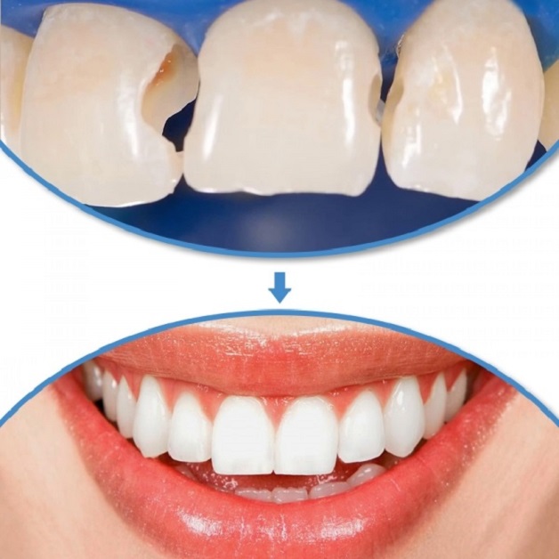 Hình ảnh trước và sau hàn răng là lời giải đáp thuyết phục cho câu hỏi "Có nên hàn răng không"