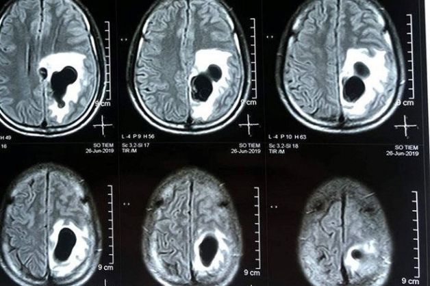 Chỉ định chụp cộng hưởng từ sọ não nhằm phát hiện các tổn thương và bệnh lý ở vùng sọ não