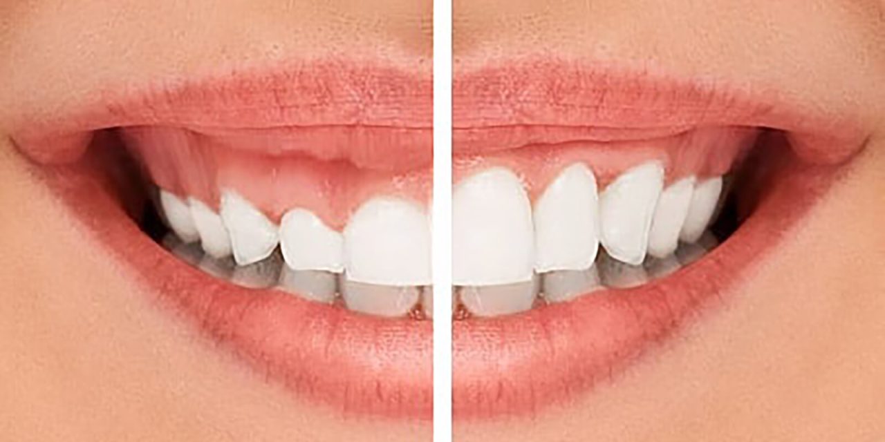 Tìm hiểu về cách điều trị cười hở lợi tại nha khoa