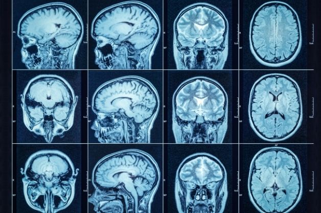 Chụp cắt lớp vi tính sọ não cho hình ảnh chi tiết, rõ nét và đa góc góc chụp