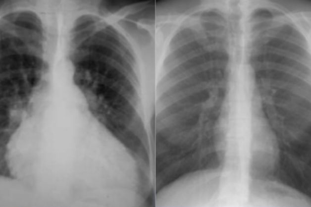 X quang tim được xem là kỹ thuật quan trọng trong việc đánh giá và xác định kích thước bóng tim