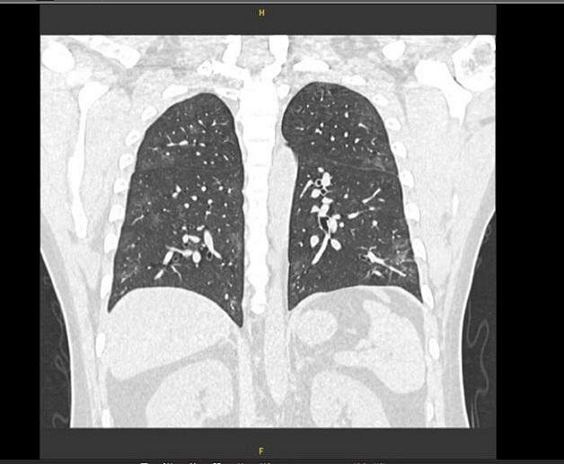 Chụp cắt lớp vi tính phổi 