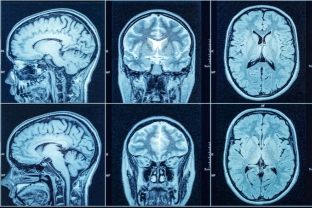 Chỉ định chụp CT sọ não giúp chẩn đoán các bệnh lý hoặc tổn thương sọ não