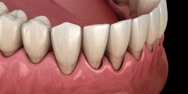 Cao răng đen và 1 số cách khắc phục