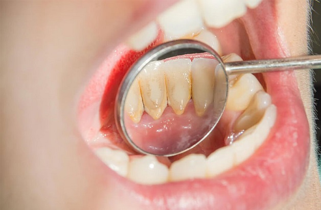 Làm thế nào để giảm đau sau khi lấy cao răng?
