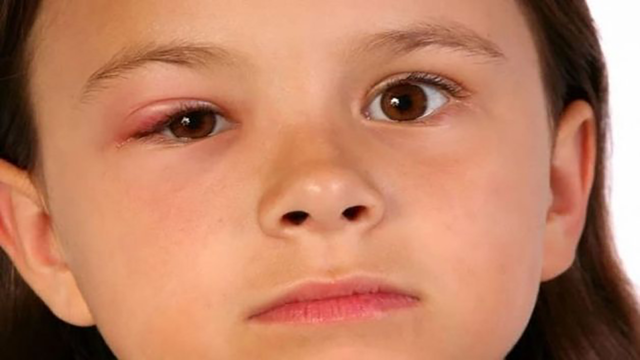 Tại sao mắt bị chai làm sao để chữa trị?