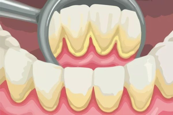 Nguyên nhân viêm quanh cuống răng là do cao răng không được loại bỏ thường xuyên khiến vi khuẩn tích tụ gây bệnh