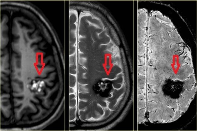Xác định các tổn thương về não bộ nhờ ứng dụng chụp MRI