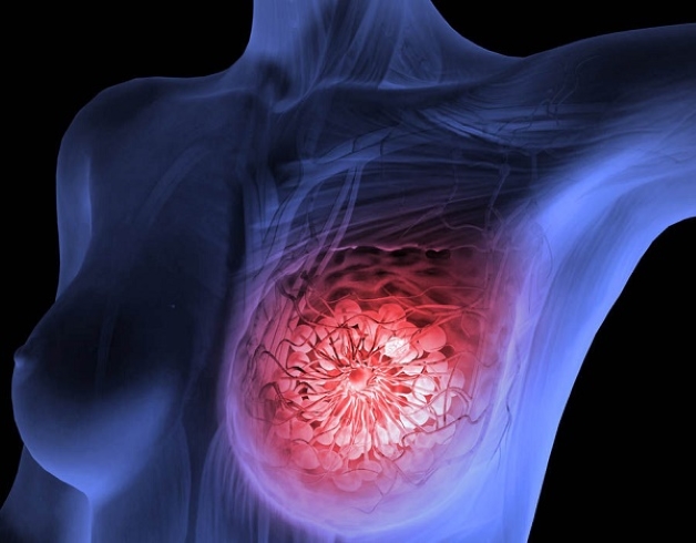 Ung thư vú là một dạng khối u ác tính có khả năng gây tử vong cao ở nữ giới nếu như người bệnh không được phát hiện sớm và điều trị kịp thời