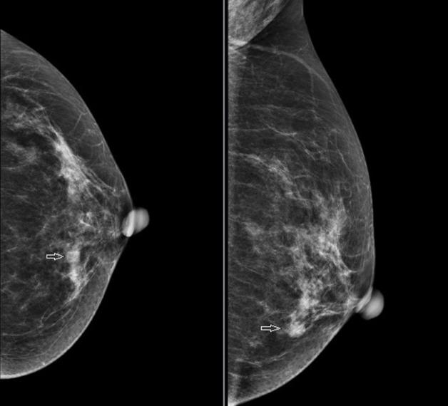Chụp X-quang tuyến vú là một thủ thuật được sử dụng bằng tia X với cường độ thấp và chiếu vào các mô tuyến vú để thu lại được hình ảnh tại tuyến vú