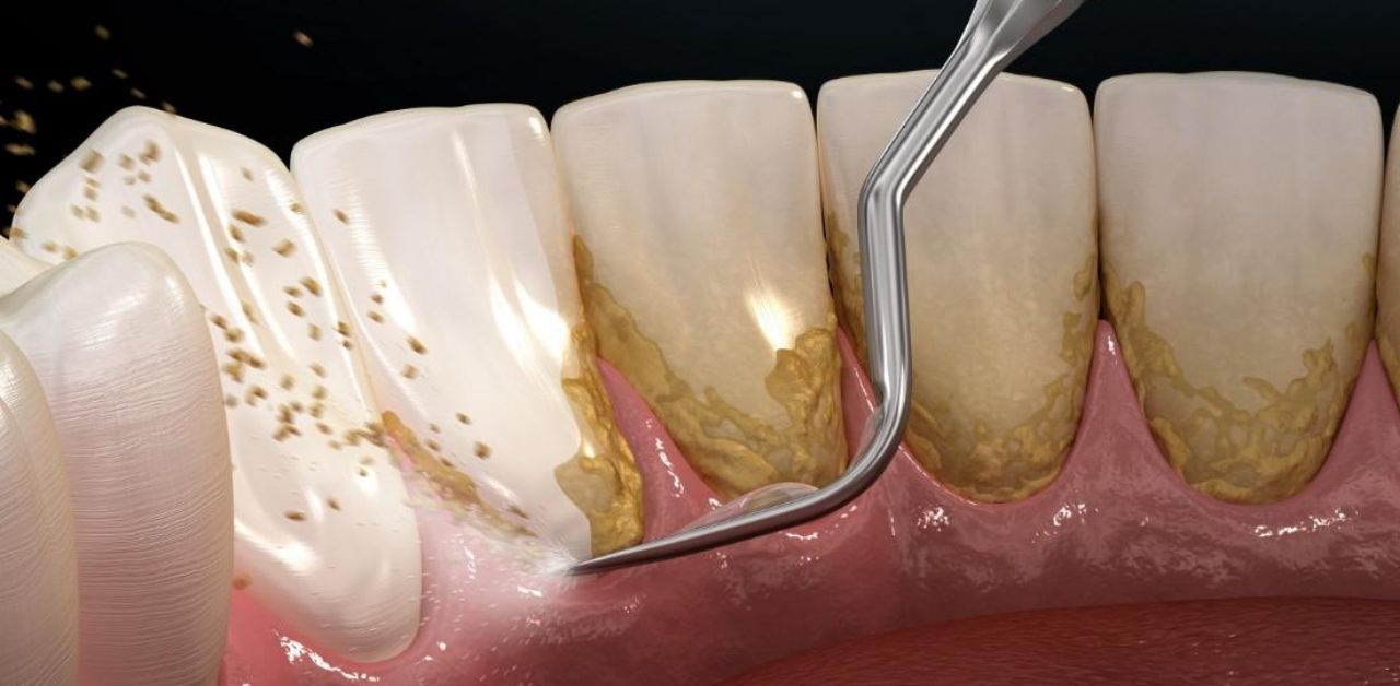 What are the benefits of using ultrasound technology for tooth scaling?