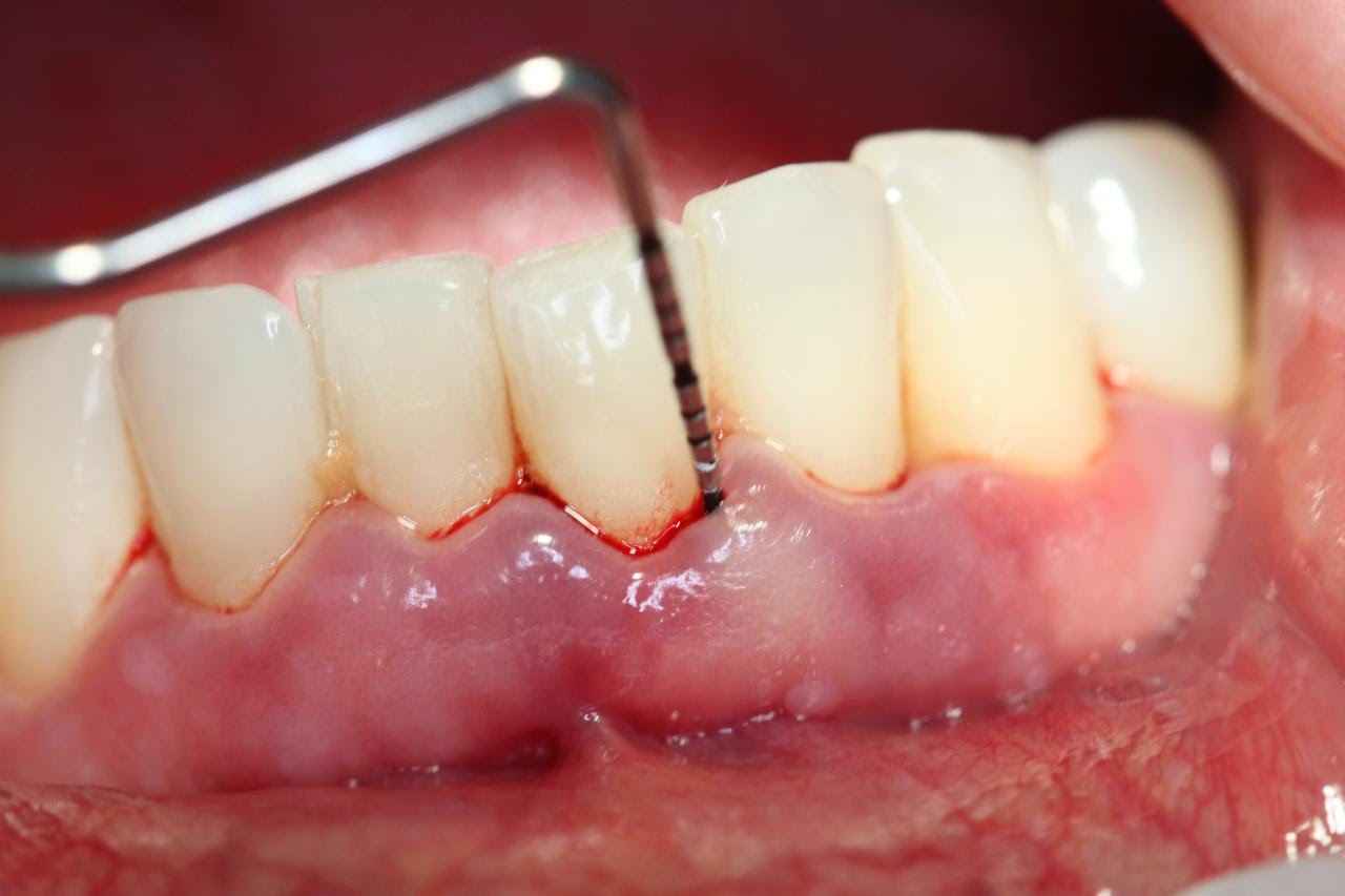 What are the causes and symptoms of bleeding from deep cavities in teeth?