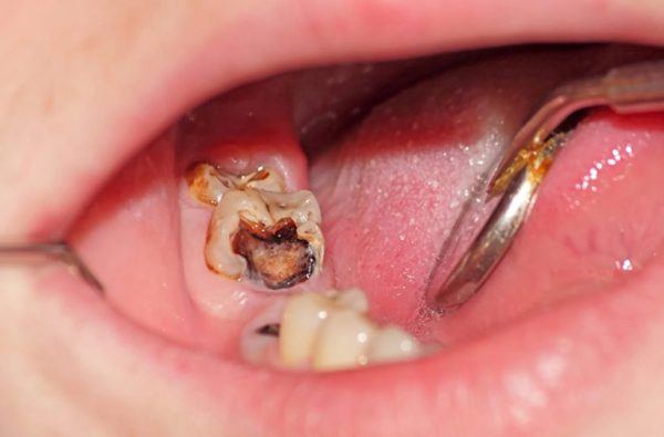 Răng sâu chảy máu là hiện tượng vô cùng phổ biến mà rất nhiều người có thể gặp phải