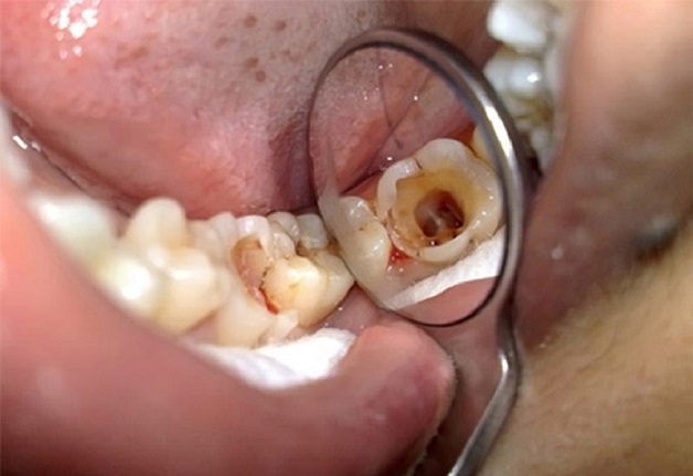 Răng số 8 bị sâu vỡ là vấn đề phổ biến bởi răng này thường có xu hướng mọc ở sâu trong cung hàm