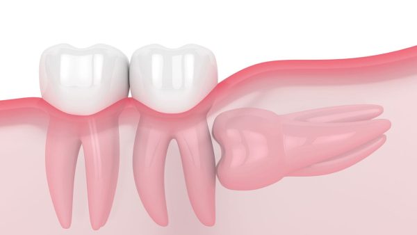 Răng số 8 là tên gọi của răng khôn - răng hàm lớn thứ 3 trên cung hàm