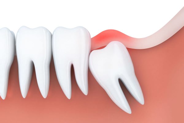 Răng số 8 mọc ngầm phải làm sao? Theo các bác sĩ nha khoa, răng khôn mọc ngầm cần được nhổ bỏ để tránh biến chứng nguy hiểm xảy ra