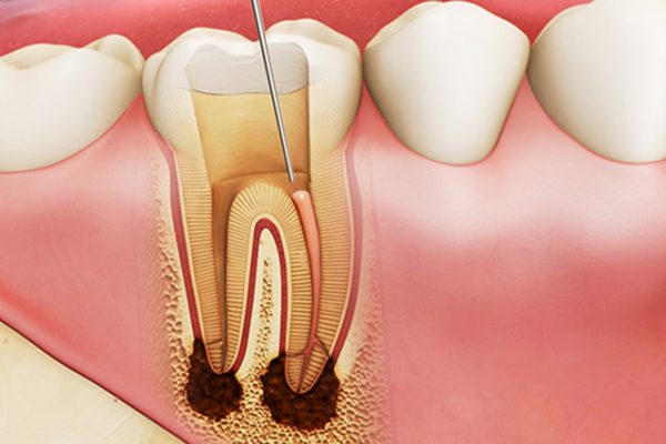 Răng sâu bị chảy máu là dấu hiệu cảnh báo sức khỏe răng miệng của bạn đang gặp vấn đề
