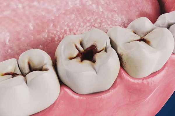 Sâu răng khi xuất hiện mủ, dịch bất thường được các bác sĩ đánh giá là mức độ nguy hiểm
