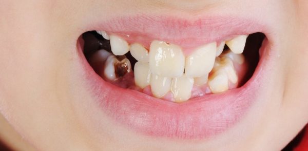 Sâu răng xuất hiện mủ nếu không được điều trị kịp thời, bệnh có thể gây ra những biến chứng vô cùng nguy hiểm như viêm nha chu, mất răng...