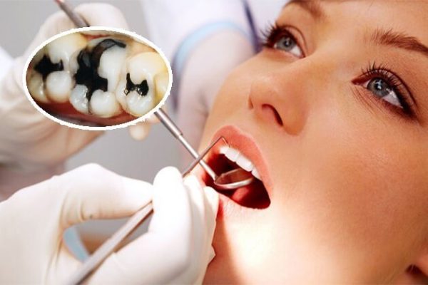 Với thắc mắc "sâu răng có nên nhổ không", tùy thuộc vào tình trạng răng cụ thể cũng như mức độ sâu răng mà bác sĩ sẽ chỉ định phương pháp phù hợp