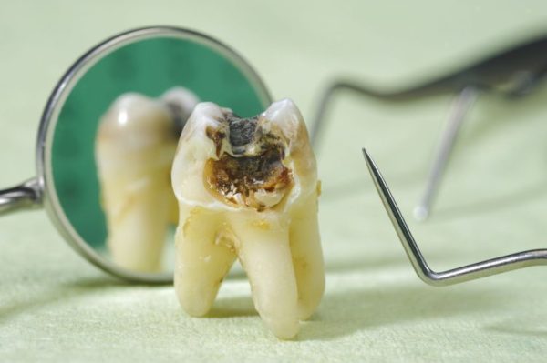 Sâu răng là vấn đề phổ biến mà hầu như chúng ta ai cũng từng gặp phải