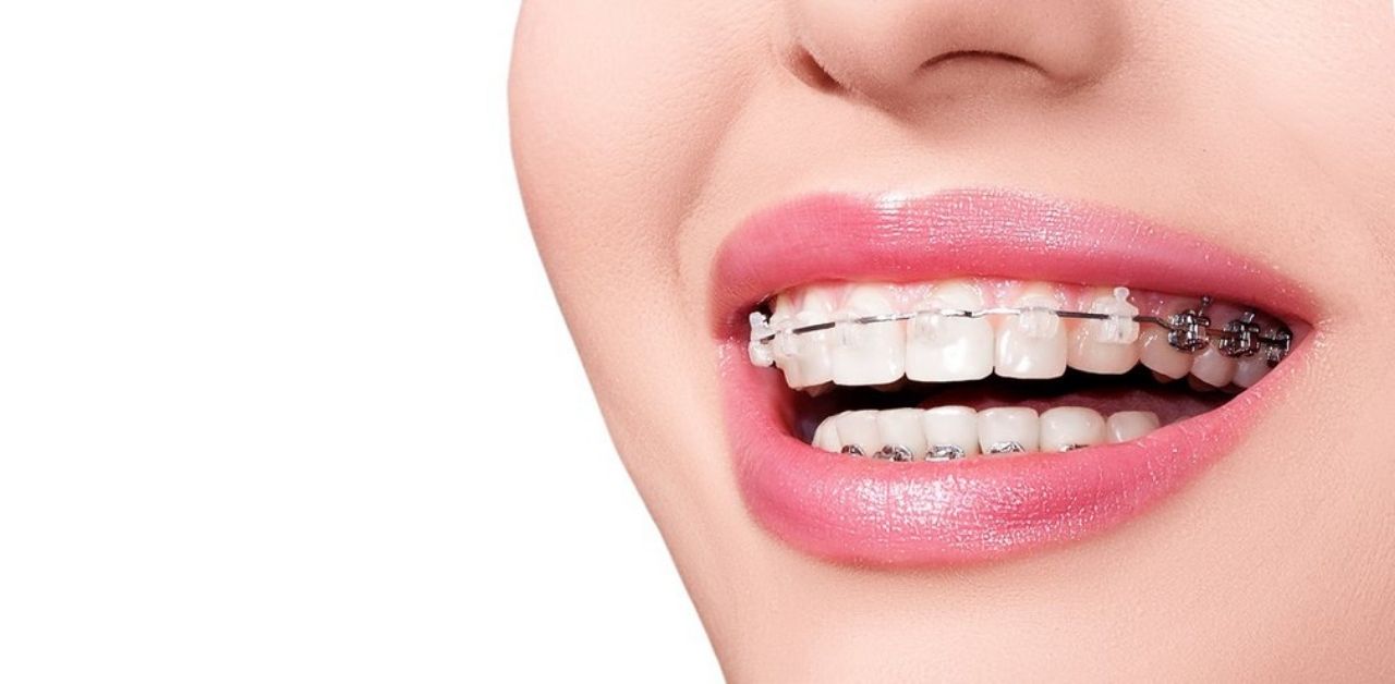 Tại sao cần điều trị sâu răng trước khi niềng răng?
