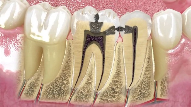 Tình trạng sâu răng cửa có thể xuất phát từ nhiều nguyên nhân khác nhau