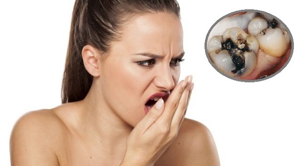 Sâu răng hôi miệng là vấn đề phổ biến mà rất nhiều người gặp phải
