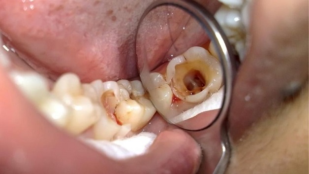 Sâu răng là tình trạng răng bị tổn thương, mất mô cứng, đây là kết quả của quá trình hủy khoáng do vi khuẩn ở mảng bám răng gây ra
