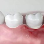 Viêm chân răng: Nguyên nhân gây bệnh và cách điều trị dứt điểm