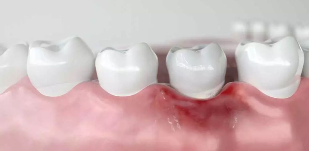 Triệu chứng của viêm lợi và viêm chân răng là gì?
