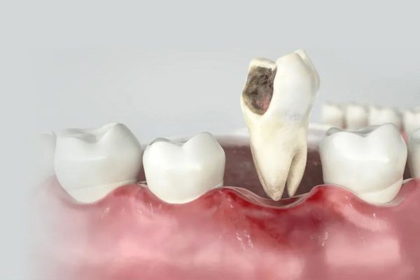 Tình trạng viêm nếu không được điều trị kịp thời và đúng cách sẽ gây ra những biến chứng nguy hiểm như mất răng