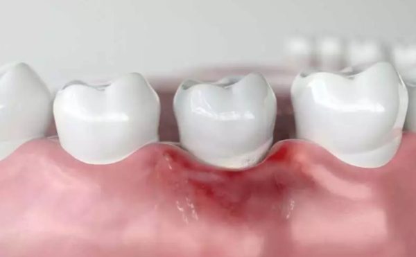 Theo các bác sĩ nha khoa TCI, có hai nguyên nhân chính gây nên tình trạng viêm là do bệnh nha chu và do bệnh về tủy răng